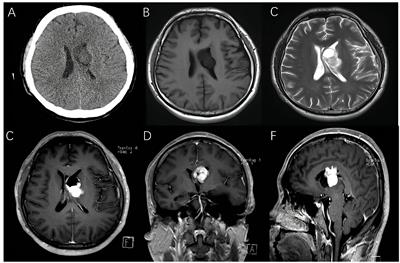 Hemangioblastoma in the lateral ventricle: An extremely rare case report